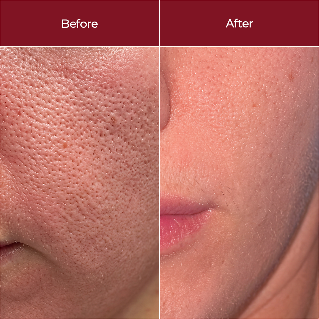 Resurfacing Serum