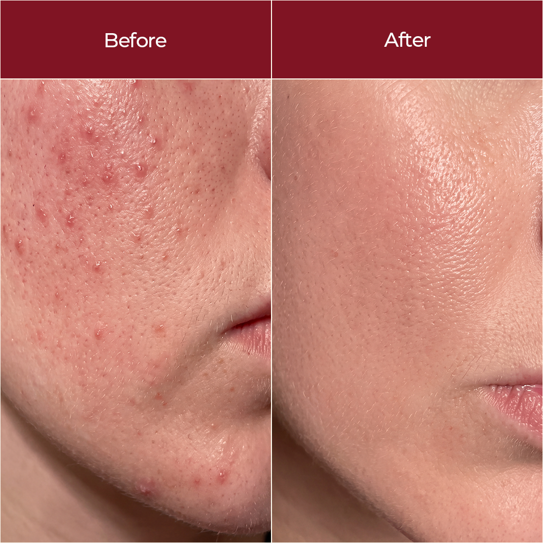 Aze10 clear Serum