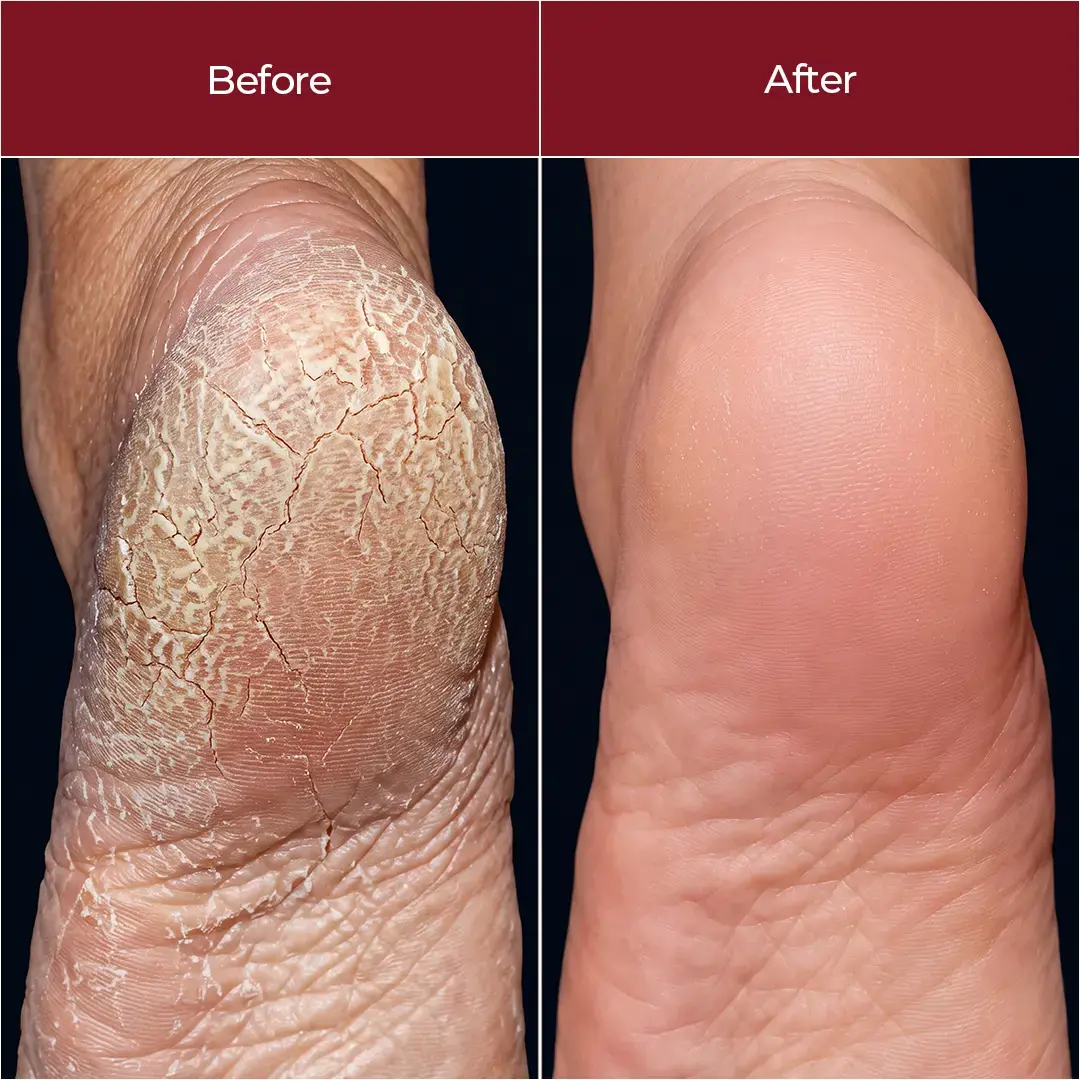 Anti-Crack Foot Cream