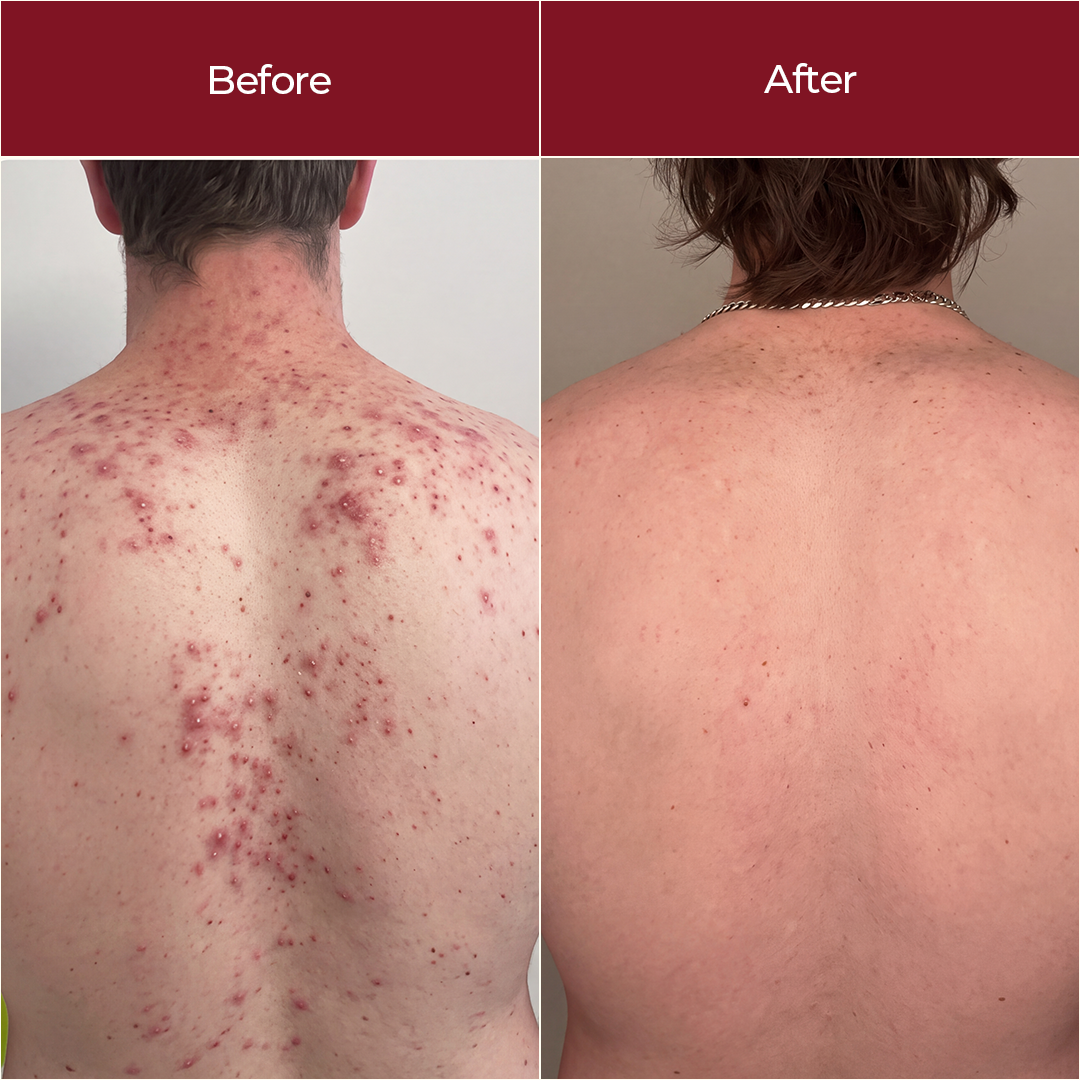 2% Salicylic Acid Body Wash